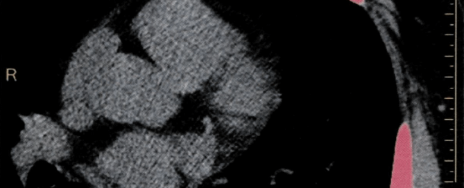 Heart scan