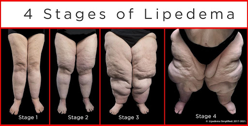 Stages of Lipedema