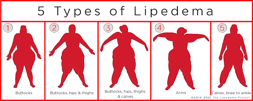 Stages of Lipedema