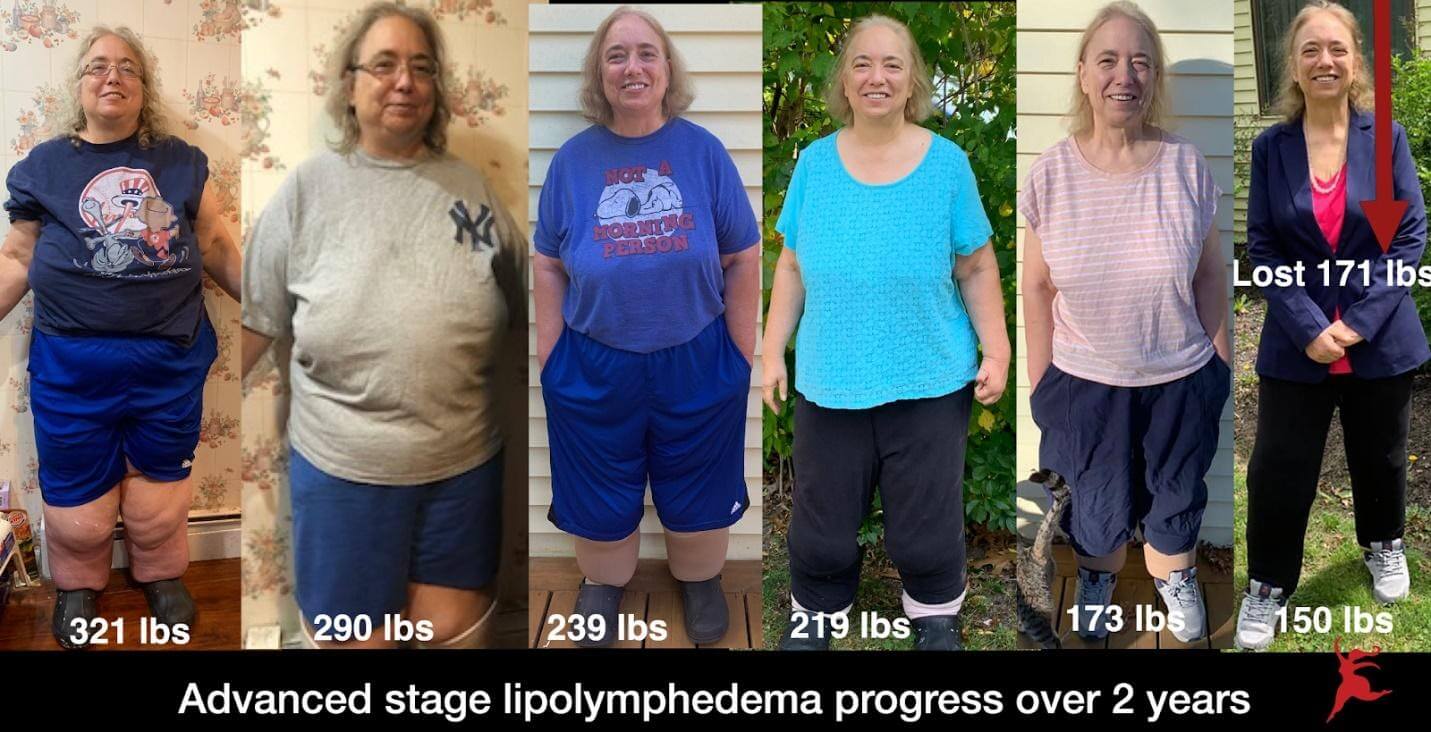 Stages of Lipedema